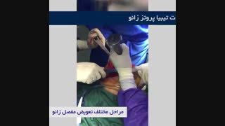 جراحی تعویض مفصل زانو