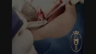ویدیو کاشت ایمپلنت یک روزه | کلینیک دندانپزشکی مدرن