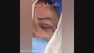 جراحی زیبایی پلک بلیچینگ