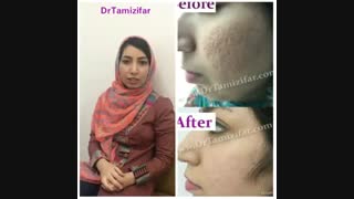 درمان جای جوش