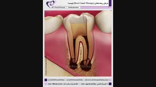 درمان ریشه دندان | دکتر فاضل فیروزی بلیچینگ دندان