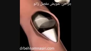 جراحی تعویض مفصل زانو