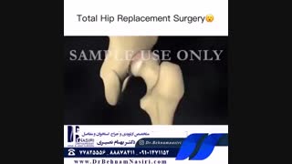 تعویض مفصل لگن