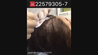 مزوتراپی مو کلینیک پوست