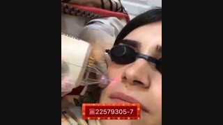 برداشتن خال لیفت صورت