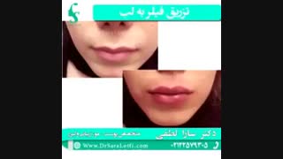 تزریق فیلر در لب برداشتن خال