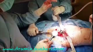 جراحی تعویض کامل مفصل ران توسط دکتر جواهری