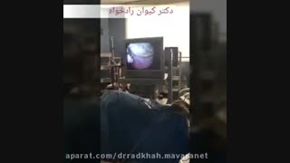 تومور خوش خیم مثانه