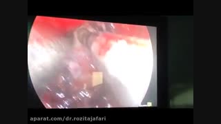 جراحی مهره های فوقانی گردن در محل آسیب به نخاع