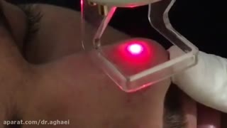 لیزر فراکشنال CO2 لیفت صورت