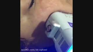 انجام هایفوتراپی توسط دکتر حمیده آقایی متخصص پوست و موی خوب در تهران ارتودنسی