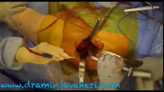 بهترین زمان برای انجام عمل جراحی تعویض کامل مفصل لگن