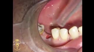 کاشت ایمپلنت بدون برش لثه در 5 دقیقه|کلینیک دندانپزشکی مدرن