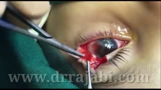 جراحی ترمیم پلک پایین کودک ۲ونیم ساله