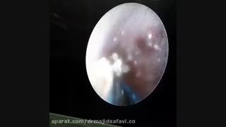 درمان آندوسکوپ سنک