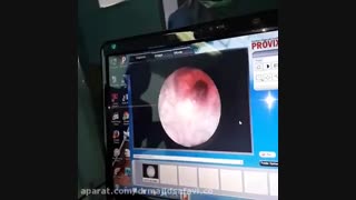 تعبیه استنت در محل تنگی مجرای ادرار