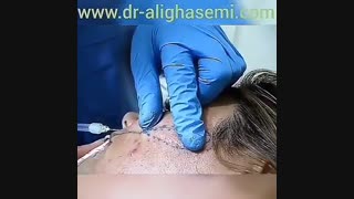 تزریق ژل به گونه برداشتن توده
