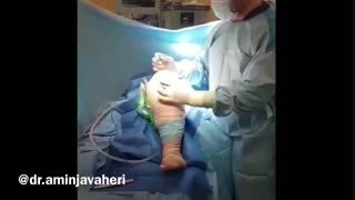 جراحی تعویض مفصل زانو