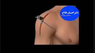 تعویض مفصل شانه