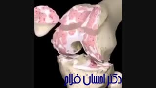 عمل تعویض مفصل زانو