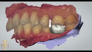ویدئو مراحل کاشت ایمپلنت به روش  دیجیتال