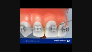 نحوه صحیح کشیدن نخ دندان زمان ارتودنسی ثابت