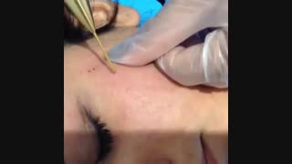 مزوتراپی لیفت پیشانی