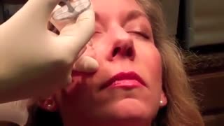 تزریق  ژل صورت