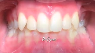 ارتودنسی ثابت با سیستم دیمون