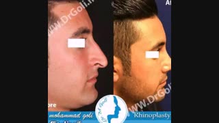 نمونه جراحی بینی