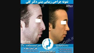 جراحی بینی مردان