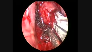 جراحی تومور هیپوفیز در حین بارداری